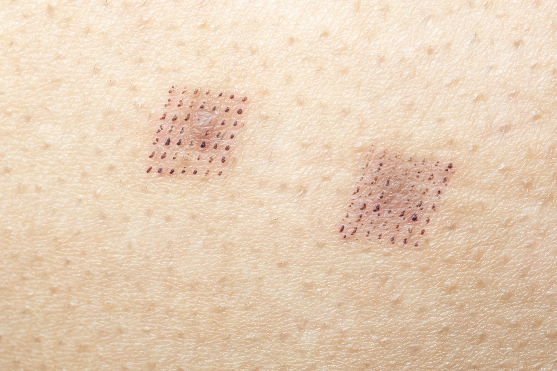 Fraktionierte Behandlung mit dem CO₂-Laser