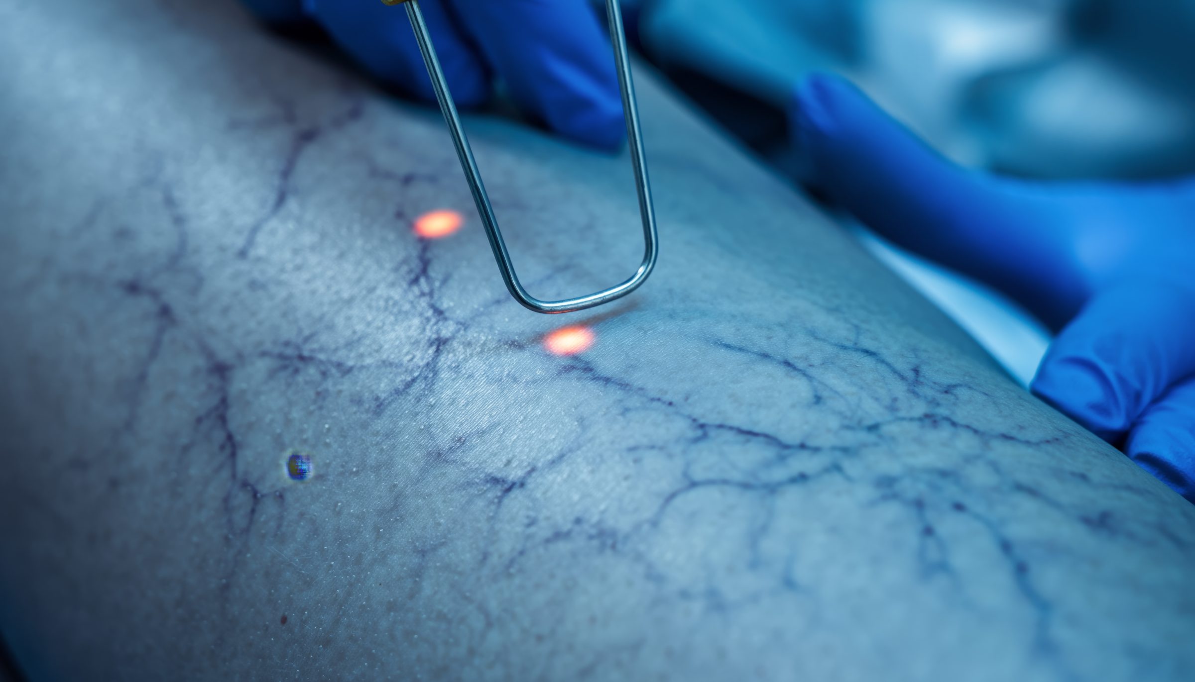 Laserbehandlung von Besenreisern am Bein