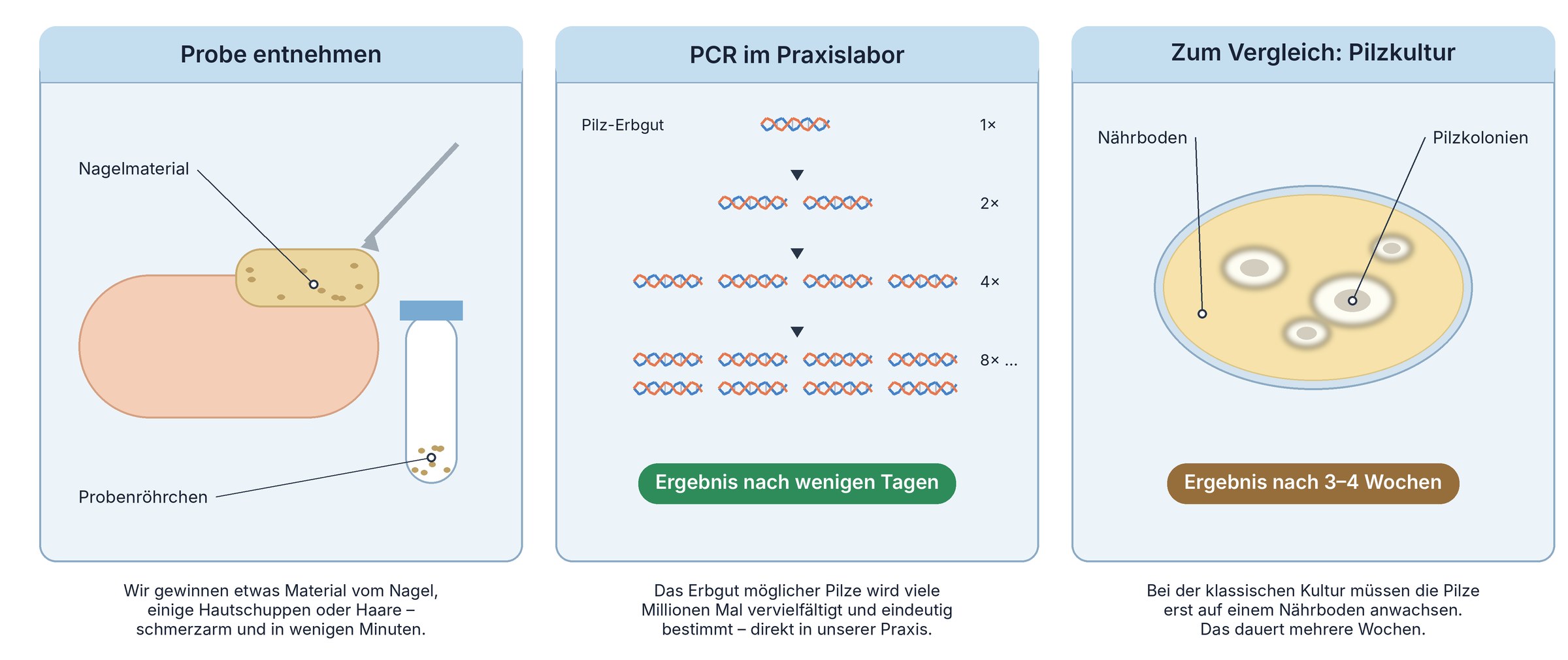 Grafik in drei Schritten: Probe vom Nagel entnehmen, PCR im Praxislabor vervielfältigt das Erbgut des Pilzes mit Ergebnis nach wenigen Tagen, zum Vergleich wächst die klassische Pilzkultur auf einem Nährboden und braucht 3 bis 4 Wochen.