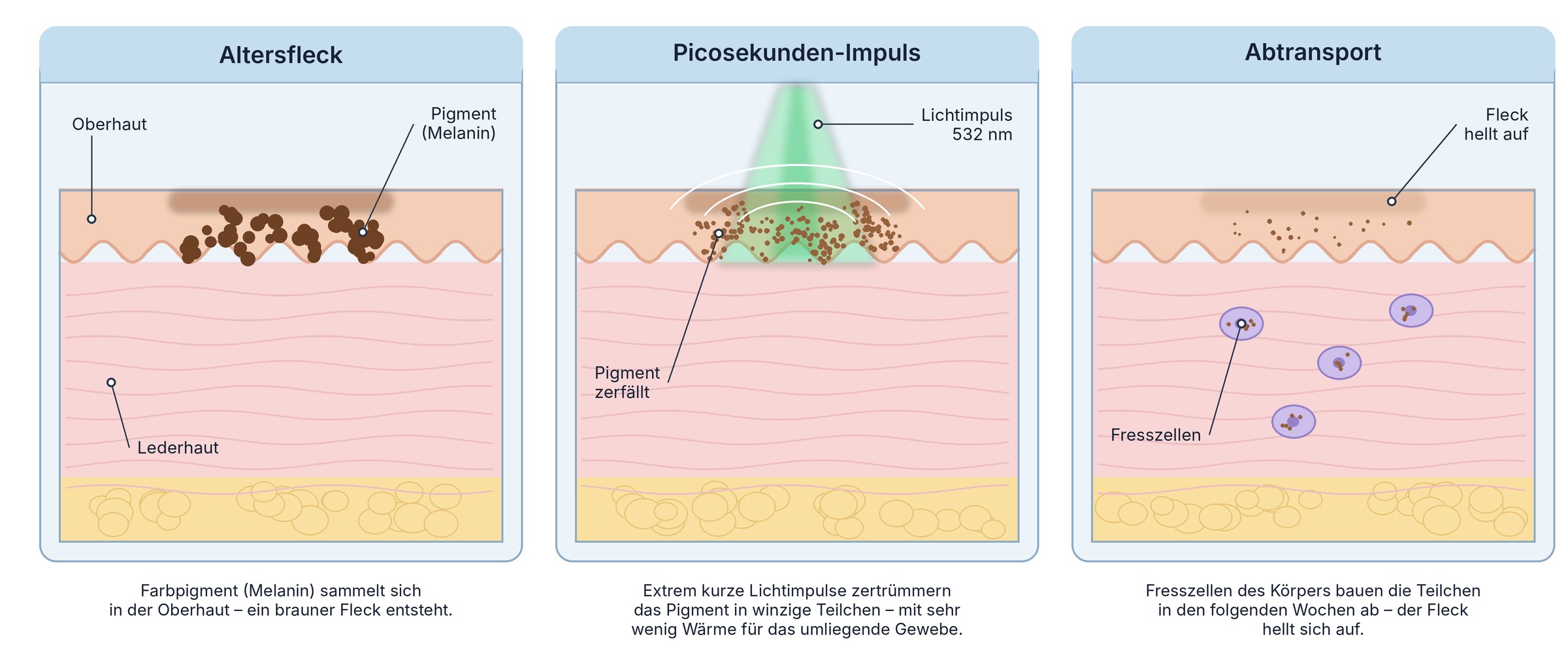 Grafik in drei Schritten: Beim Altersfleck sammelt sich Pigment in der Oberhaut. Der Picosekunden-Impuls mit 532 nm zertrümmert das Pigment in winzige Teilchen. Fresszellen bauen die Teilchen in den folgenden Wochen ab, der Fleck hellt sich auf.